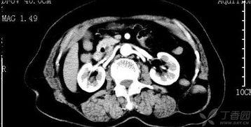 腰椎ct视频,全面解析腰椎病变与损伤